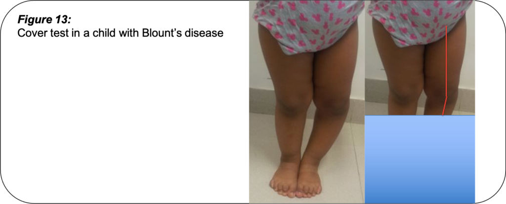 Bowlegs and Knock-knees - PinnacleOrthoCentre