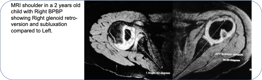 MRI Shoulder