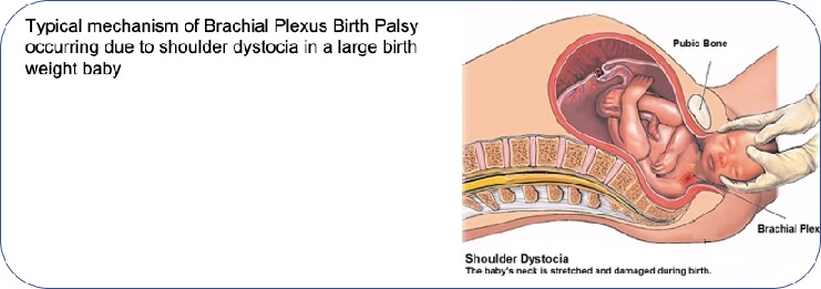 brachial plexus