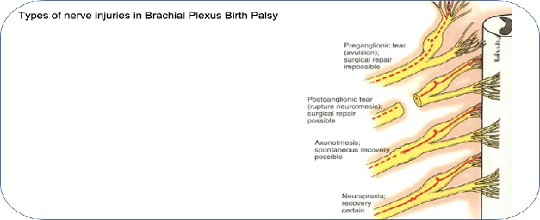 types of nerve injuries