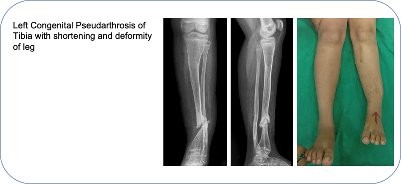 Congenital Pseudarthrosis of Tibia