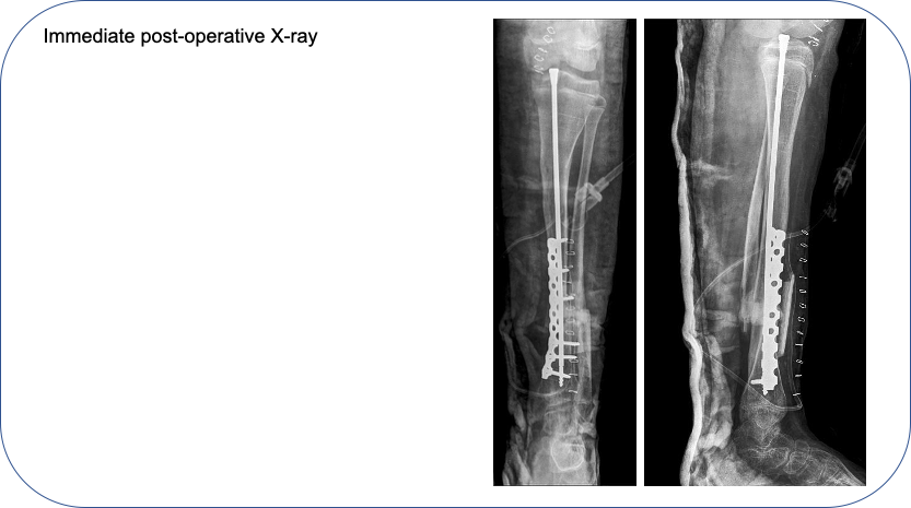 Congenital Pseudarthrosis of Tibia