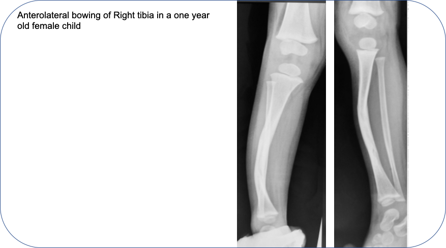 Congenital Pseudarthrosis of Tibia