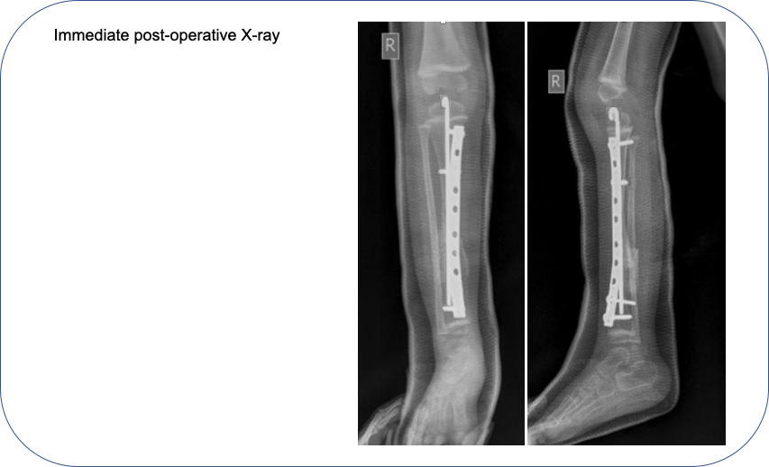 Congenital Pseudarthrosis of Tibia CPT