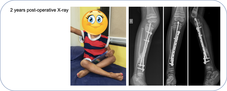 Congenital Pseudarthrosis of Tibia