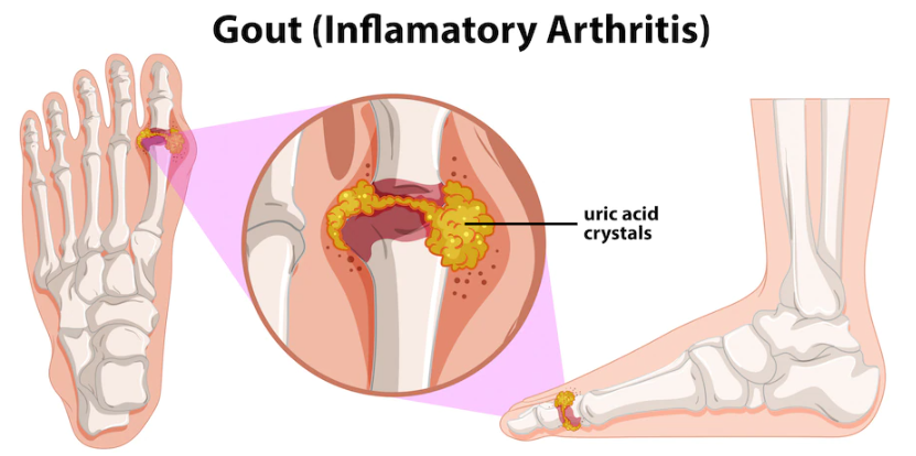 arthritis pain in feet