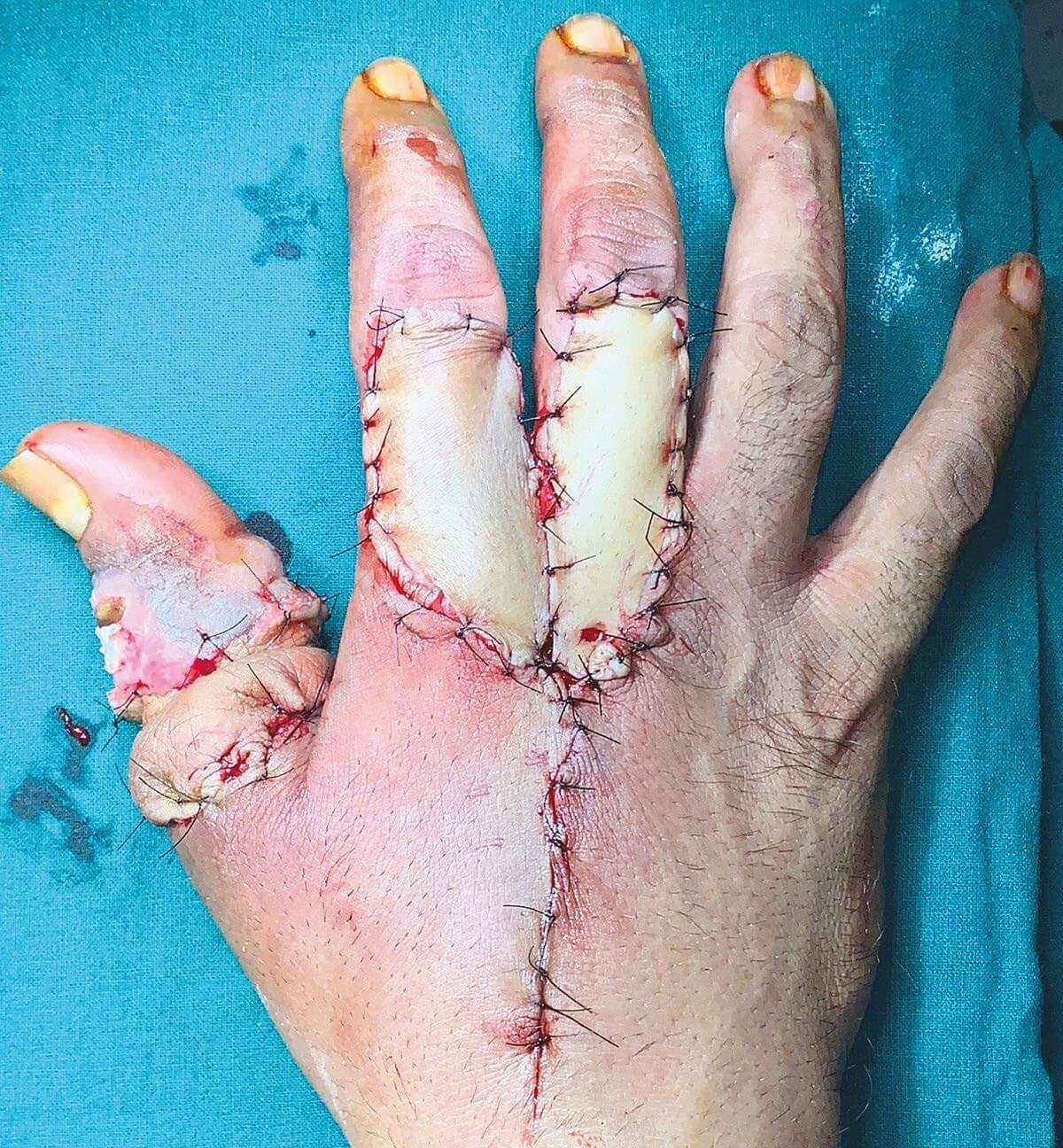 Staged Reconstruction of Chronic Constriction of Thumb Caused by Stuck Ring