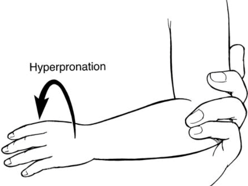 hyperpronation