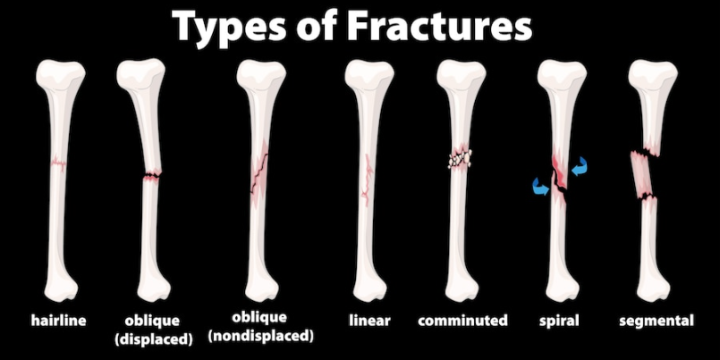 types of bone fracuture