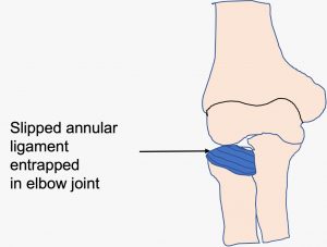 slipped annular ligament