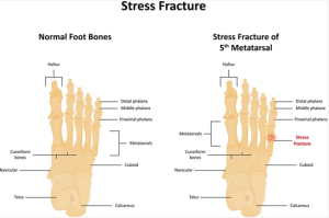 stress fracture in foot