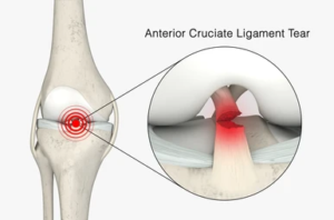 ACL Injury symptoms and treatment