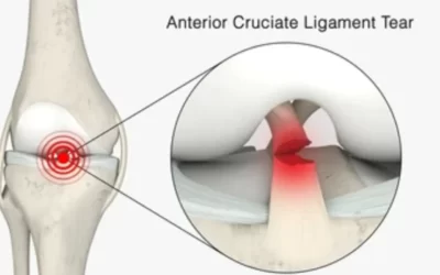 What is Anterior Cruciate Ligament Injury?