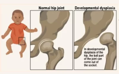 Screening Guidelines for Developmental Dysplasia of Hip in India