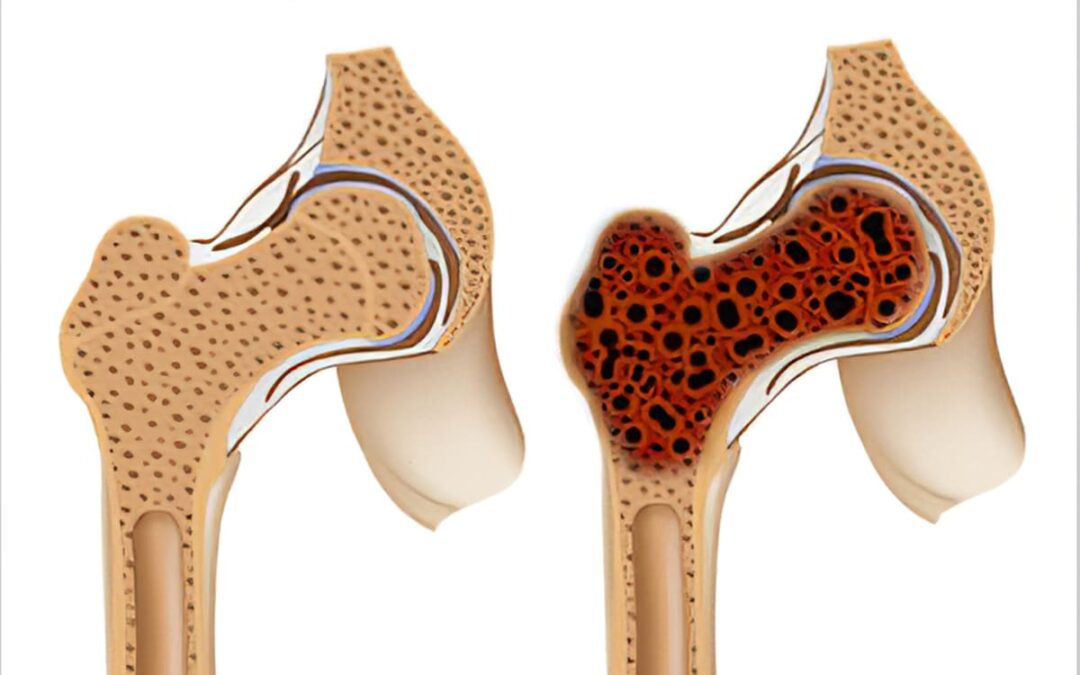 How to Manage Bone Cancer Pain