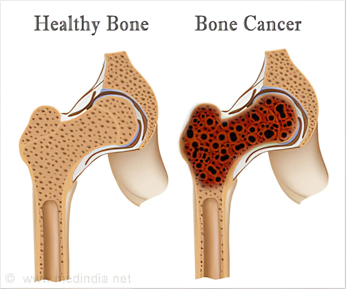 Bone & joint pain: breast cancer side effects