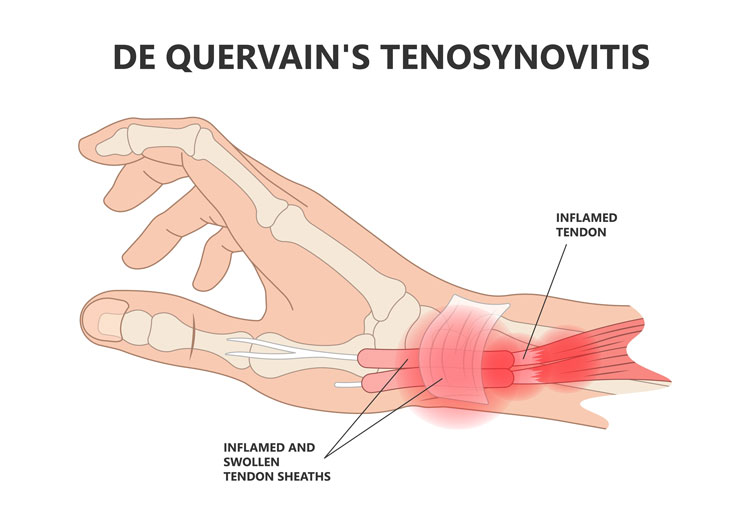 de quervain tenovaginitis