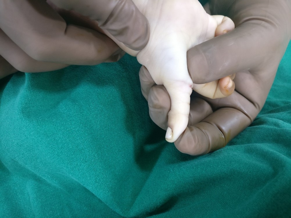 Correction of Paediatric trigger thumb after surgery