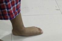 Flatfoot in standing