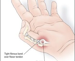 Trigger Finger and Trigger Thumb in Children