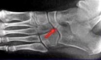 Rigid flatfoot due to tarsal coalition