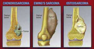 Types of Pediatric Bone Cancer