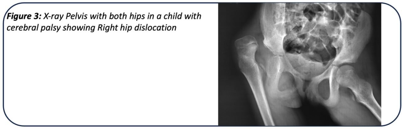 Hip Problems in Children with Cerebral Palsy - PinnacleOrthoCentre