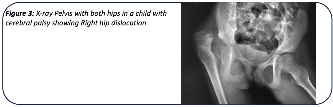 X-ray pelvis with both hips