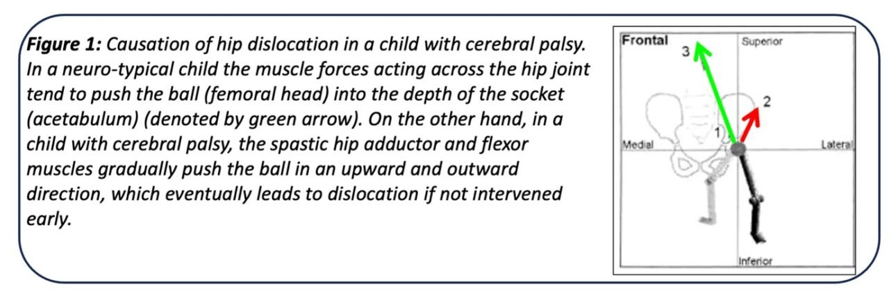 Hip Problems in Children with Cerebral Palsy - PinnacleOrthoCentre