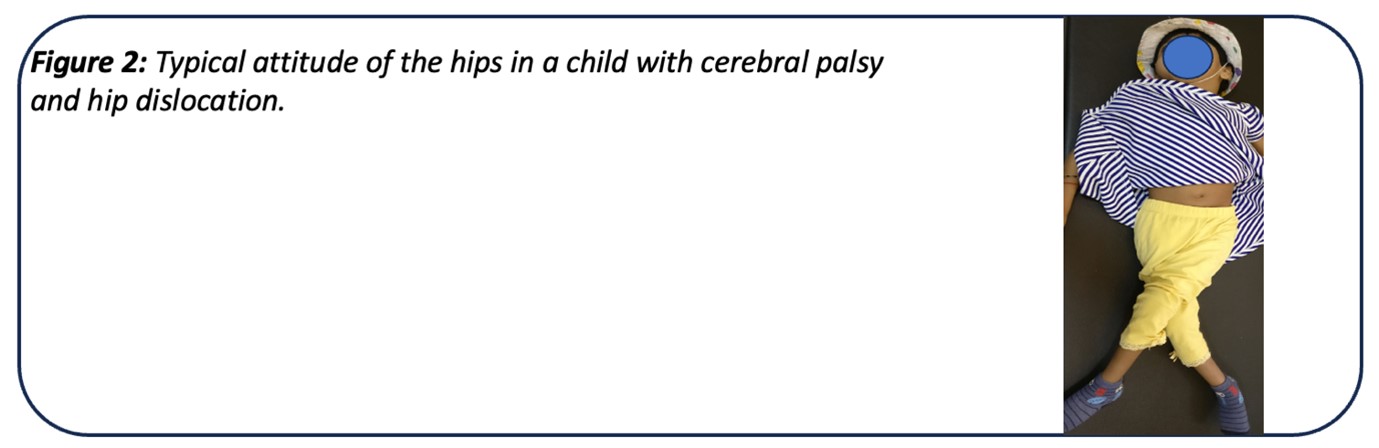 hip dislocation in child