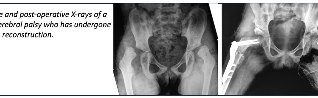 Hip Problems in Children with Cerebral Palsy