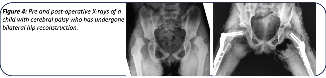 pre and post operative xrays of child