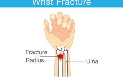 Hand and Wrist Fracture: Symptoms, Types and Treatment