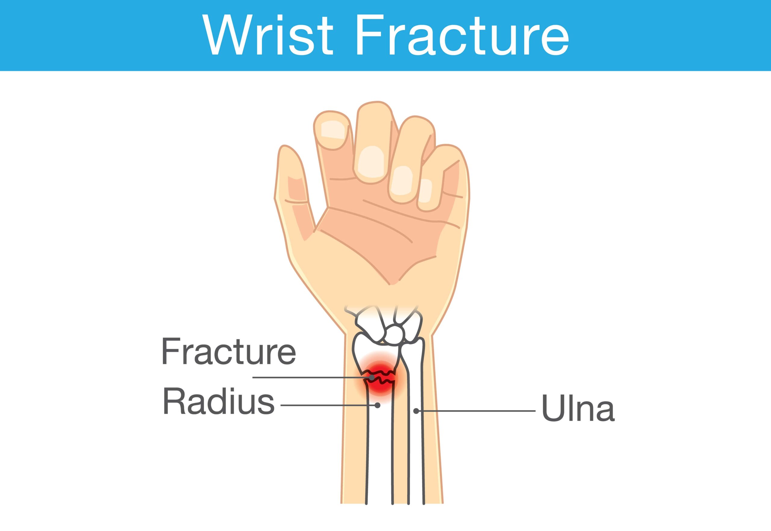 wrist fracture – PinnacleOrthoCentre