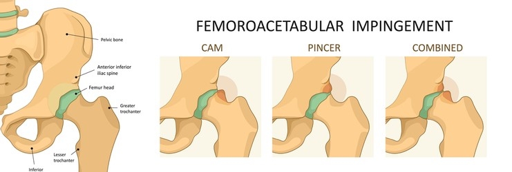 Femoroacetabular Impingement