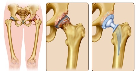 Total Hip Replacement