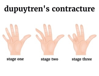 Dupuytren Contracture stages