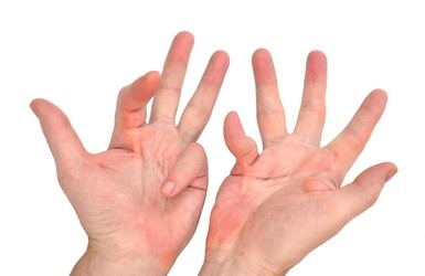 Dupuytren Contracture: Causes, Symptoms and Treatment