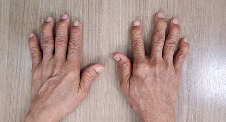 Hand Surgery in Rheumatoid Arthritis