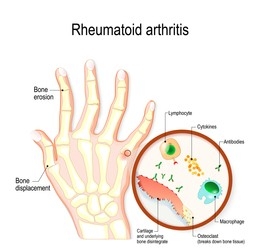 Hand and wrist surgery in Rheumatoid Arthritis