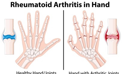 Rheumatoid Arthritis