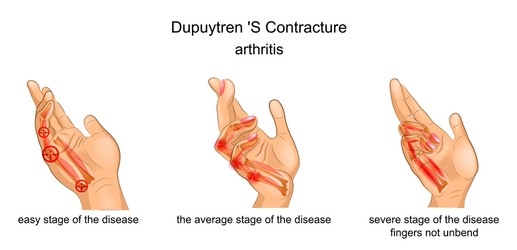Symptoms of Dupuytren Contracture