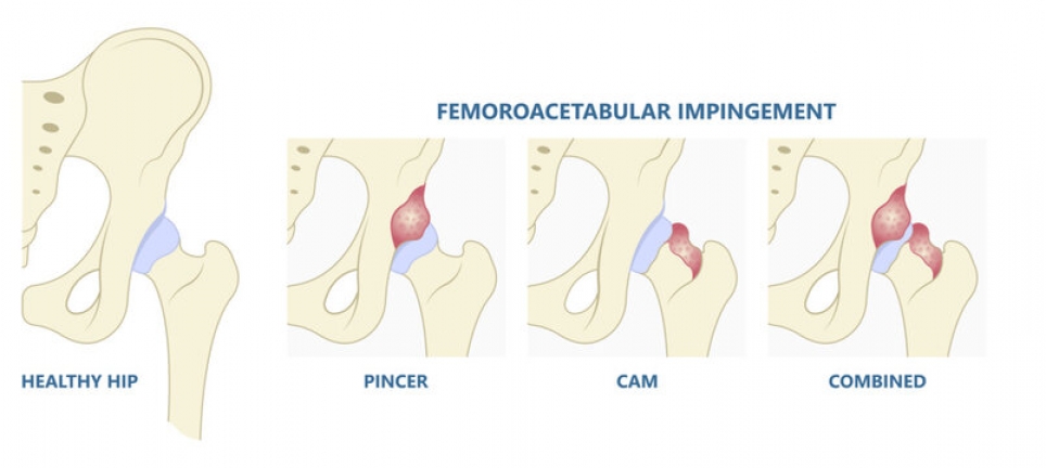 Femoroacetabular Impingement