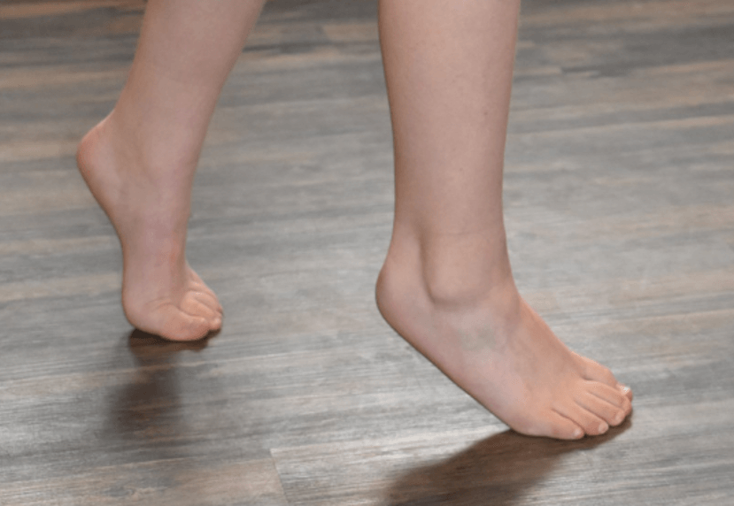 Idiopathic Toe Walking