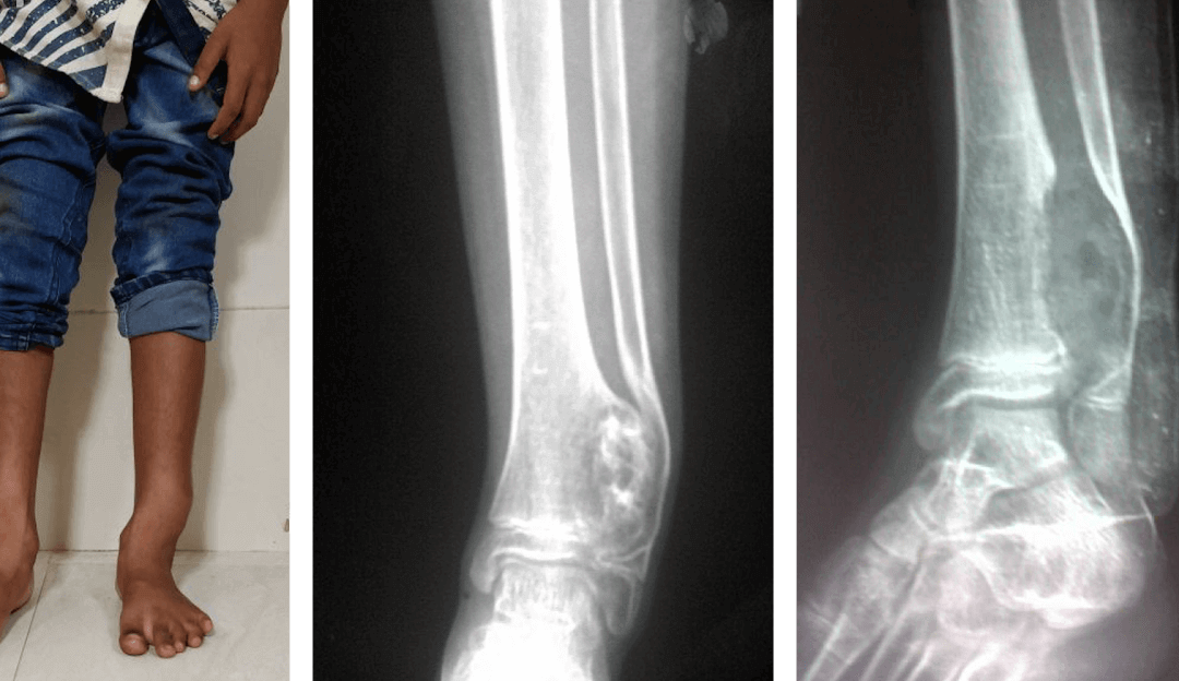Hereditary Multiple Exostoses