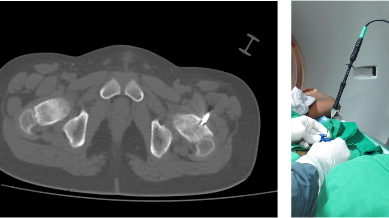 CT scan guided Radiofrequency Ablation