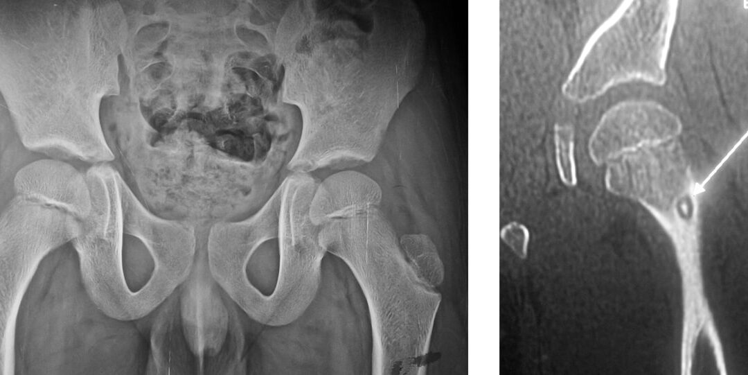 Osteoid Osteoma: Symptoms, Causes & Treatment