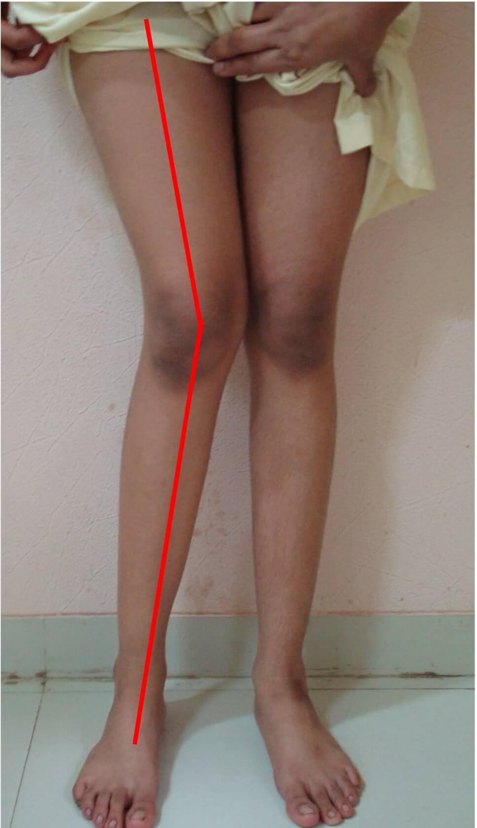osteotomy surgery for knock knees