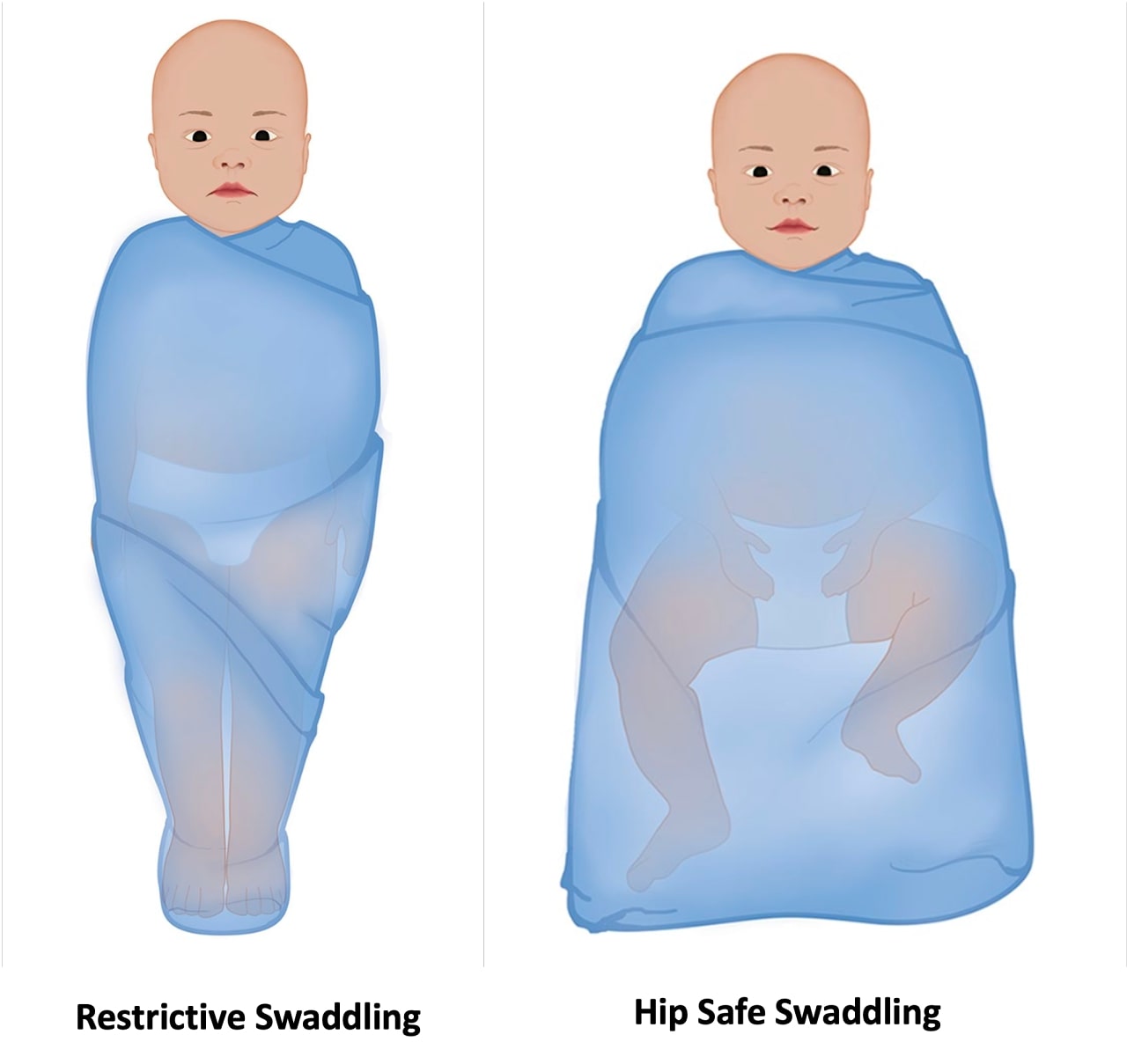 Restrictive and Hip-safe swaddling