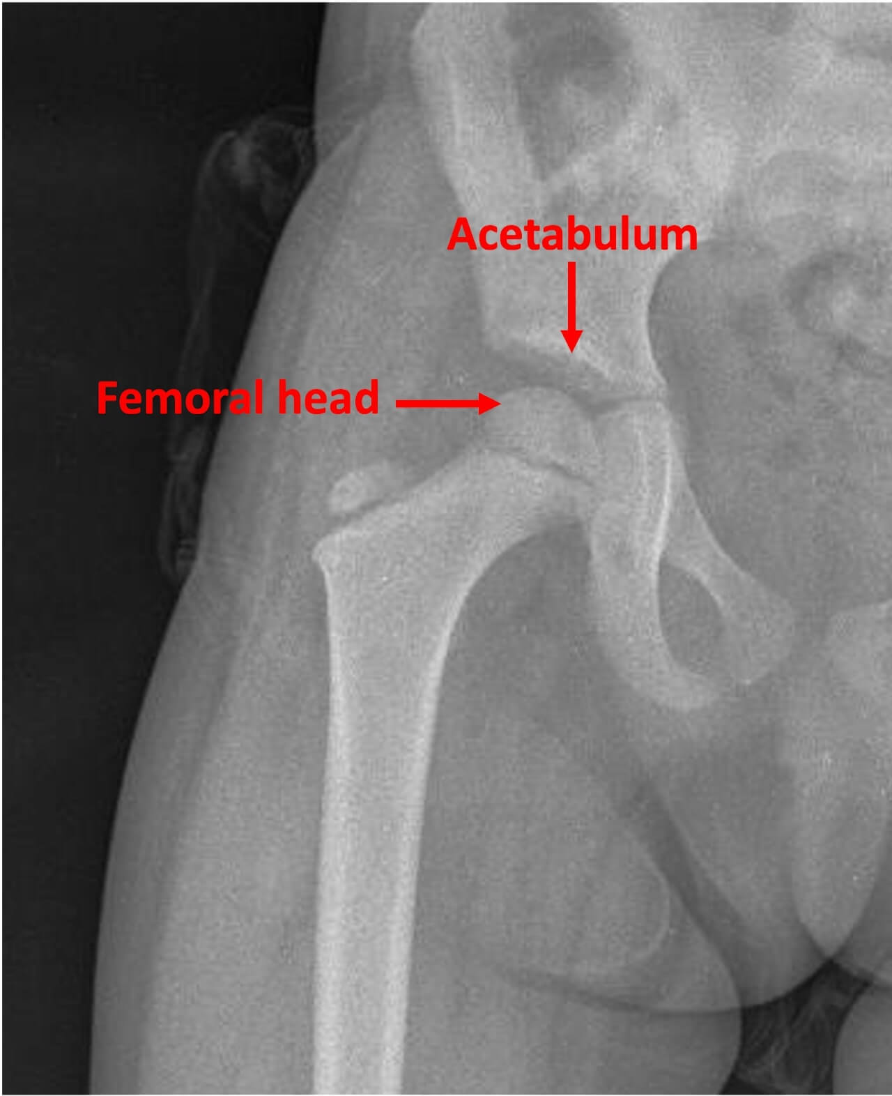 hip joint is a ball-and-socket joint